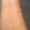 Rash caused by skin allergic to sweat, dust and viruses.