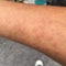 Rash caused by skin allergic to sweat, dust and viruses.