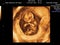 real 3d ultrasound diagnosis of a pregnant woman, duration: 12 w