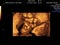 real 3d ultrasound diagnosis of a pregnant woman duration 12 wee