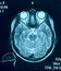 Real brain MRI slide of a young woman. Patient\'s and clinic\'s na