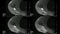 Real MRI Scan of Doctor examining male shoulder and finding a lesion, an oedema and the very rare paraglenodiale Cyst