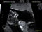 real ultrasound diagnosis of a pregnant woman duration 12 weeks