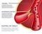 Realistic Atherosclerotic Vessels Anatomy Banner