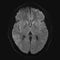 Realistic axial image of male cerebrum with CT scan, MRI Magnetic resonance imaging layer of brain.