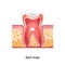 Realistic Caries Tooth Anatomy