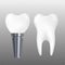 Realistic dental implant and healthy tooth isolated on transparent background.