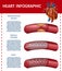 Realistic Heart Infographic Surgery Therapy Banner