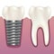 Realistic Human Tooth and Dental Implant. Vector