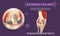 Realistic Illustration Knee Rheumatoid Arthritis