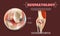 Realistic Illustration Osteoarthritis Knee Joint