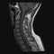Realistic image sagittal of cervical spine with CT scan, MRI Magnetic resonance imaging layer of spine neck.