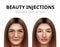 Realistic before and after vector illustration of woman having facial beauty injection.