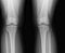 Rear knee joint x-ray of mature female with osteoarthritis