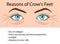 Reasons od Crows feet wrinkles, vector illustration