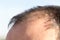 Receding hairline in men