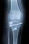 Reconstruction of a right human knee after crash