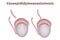 Reconstruction of the vas deferens.