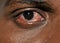 Red eyes. Indian guy. Close up of annoyed red eyes of male affected by conjunctivitis or after flu, cold or allergy.