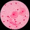 Red leukocyte in sputum gram stain