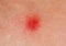 Red patch on human skin