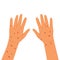 Red rash on hands. Allergy, dermatitis, psoriasis or eczema. Hands infected. Skin problems concept. Flat cartoon vector