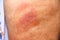 Red rash on left arm skin background of old asian woman