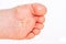 After the red rash and the strawberry tongue caused by scarlet fever the affected skin often peels - Here Skin of foot