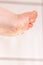 After the red rash and the strawberry tongue caused by scarlet fever the affected skin often peels - Here Skin of foot