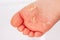 After the red rash and the strawberry tongue caused by scarlet fever the affected skin often peels - Here Skin of foot