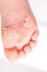 After the red rash and the strawberry tongue caused by scarlet fever the affected skin often peels - Here Skin of foot