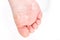 After the red rash and the strawberry tongue caused by scarlet fever the affected skin often peels - Here Skin of foot