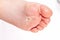 After the red rash and the strawberry tongue caused by scarlet fever the affected skin often peels - Here Skin of foot