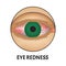 Redness of the eyes. Symptom of conjunctivitis, allergies, inflammation of the eyes. Eye redness icon. Infographics