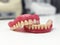 Removable dentures for the patient are made in a dental laboratory