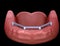 Removable Mandibular prosthesis with gum All on 4 system supported by implants. Medically accurate 3D illustration of human teeth