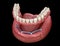 Removable Mandibular prosthesis with gum All on 4 system supported by implants. Medically accurate 3D illustration of human teeth