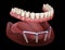 Removable Mandibular prosthesis with gum All on 4 system supported by implants. Medically accurate 3D illustration of human teeth