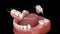 Removable partial denture, mandibular prosthesis. Medically accurate 3D animation of prosthodontics concept