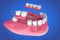 Removable partial denture. Medically accurate