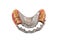 Removable partial metal denture swinglock type on white background