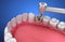 Removing the caries . Medically accurate tooth