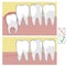 Before and after removing a wisdom tooth, a vector stock infographic with teeth on the jaw, tearing out a molar, suture and