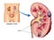 Renal cysts