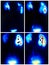 Renal hydronephrosis nuclear medicine