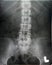 Renal pelvis spine xray (x-ray)