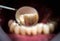 Resin crown for temporary treatment, that are used in cases when the patient has to walk away with buffed teeth from the