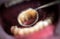 Resin crown for temporary treatment, that are used in cases when the patient has to walk away with buffed teeth from the