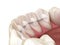 Retainers dental installed after braces treatment, Medically accurate dental 3D illustration