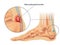 Retrocalcaneal bursitis